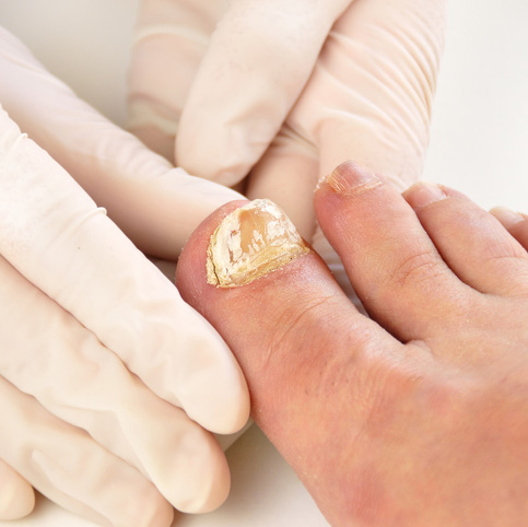 Close up afbeelding van een pedicure die een voet met een schimmelnagel bekijkt